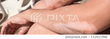 Skin with vitiligo. Female legs and arms with autoimmune disease. pigmentation Skin with vitiligo. Female legs and arms with autoimmune disease. pigmentation 132631996