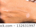 Skin with vitiligo. Female legs and arms with autoimmune disease. pigmentation 132631997