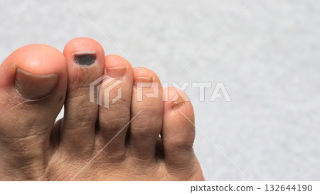 腳部指甲受傷的特寫 腳部指甲受傷的特寫 132644190