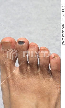 Close-up of a foot with an injured index finger nail Close-up of a foot with an injured index finger nail 132644196