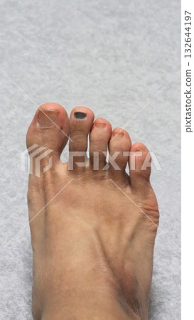 Close-up of a foot with an injured index finger nail Close-up of a foot with an injured index finger nail 132644197