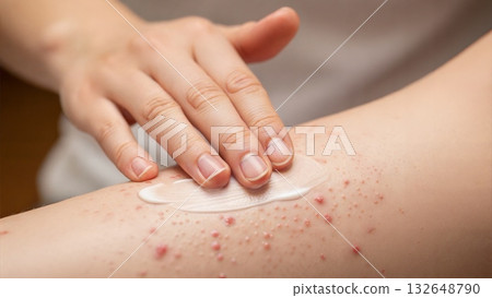 Hand Applying Cream to Skin Rash and Pimples Close Up Hand Applying Cream to Skin Rash and Pimples Close Up 132648790