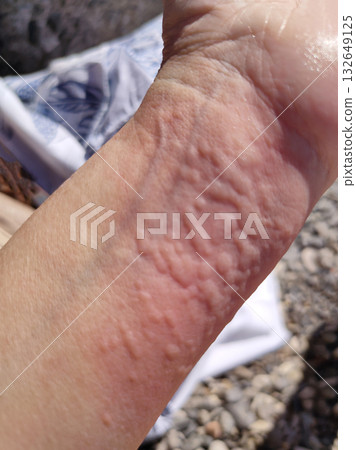 Skin Allergy Symptoms of patient - the result of contact with blooming blue-green algae cyanobacteria 132649125