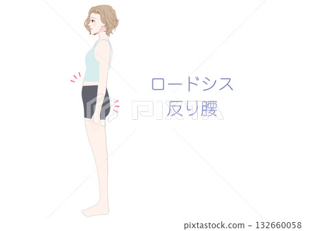 側位插圖,描繪了一位患有脊柱前凸的女性。 側位插圖,描繪了一位患有脊柱前凸的女性。 132660058