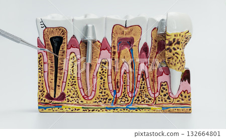 Cross-Section Tooth Model Showing Decay and Implants Cross-Section Tooth Model Showing Decay and Implants 132664801