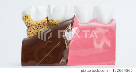 Periodontal Disease vs Healthy Gum Tooth Model 132664803
