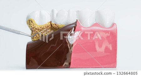 Periodontal Disease Model with Dental Tool Pointing Periodontal Disease Model with Dental Tool Pointing 132664805