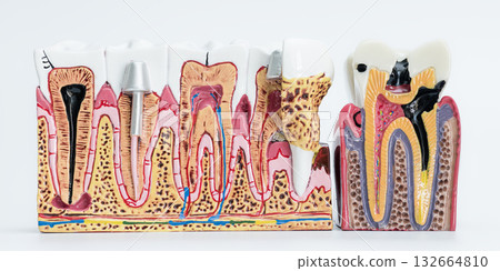 Advanced Tooth Decay and Implant Comparison Models 132664810