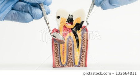 Severe Tooth Decay Demonstrated on Dental Model Severe Tooth Decay Demonstrated on Dental Model 132664811