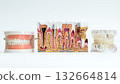 Dental Models Showing Full Denture, Tooth Anatomy, and Jaw Implants 132664814