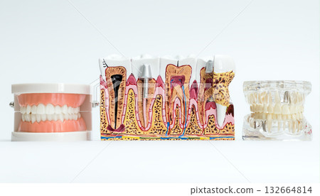 Dental Models Showing Full Denture, Tooth Anatomy, and Jaw Implants 132664814