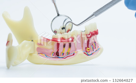 Dental Tools Examining Tooth Decay on Model 132664827