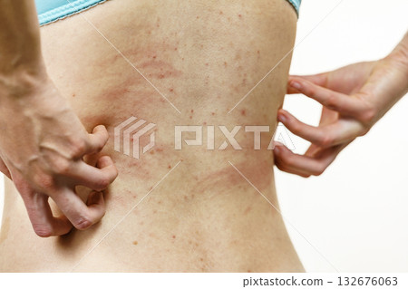 Woman scratching her itchy back with allergy rash Woman scratching her itchy back with allergy rash 132676063