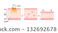 Mechanism and effects of cavitation - Cross-sectional illustration of skin / Beauty & Diet 132692678