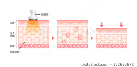 空化作用的機制與影響－皮膚橫切面示意圖 / 美容與飲食 132692678