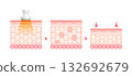 Mechanism and effects of cavitation - Cross-sectional illustration of skin / Beauty & Diet 132692679