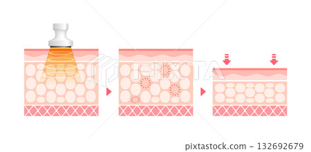 空化作用的機制與影響-皮膚橫切面示意圖 / 美容與飲食 空化作用的機制與影響-皮膚橫切面示意圖 / 美容與飲食 132692679