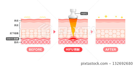 HIFU (High-intensity Fused Laser) Mechanism and Effects: Skin Cross-Section Illustration / Beauty & Diet HIFU (High-intensity Fused Laser) Mechanism and Effects: Skin Cross-Section Illustration / Beauty & Diet 132692680