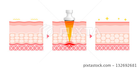高強度聚焦超音波(HIFU)的機制與效果:皮膚橫斷面示意圖 / 美容與飲食 高強度聚焦超音波(HIFU)的機制與效果:皮膚橫斷面示意圖 / 美容與飲食 132692681