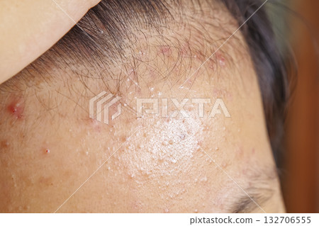 Children's skin suffering from acne and pimples Children's skin suffering from acne and pimples 132706555