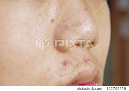 Children's skin suffering from acne and pimples Children's skin suffering from acne and pimples 132706556