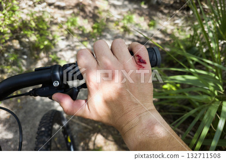 Bike rider hand injury with red blood from hitting a tree stump. Mountain biking accident 132711508