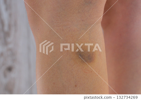 Unrecognizable woman with bruise on her leg. Close up of stain bruise wound on leg. Healing injury hematoma blood consequences of sport activity trauma. Extravasation Unrecognizable woman with bruise on her leg. Close up of stain bruise wound on leg. Healing injury hematoma blood consequences of sport activity trauma. Extravasation 132734269