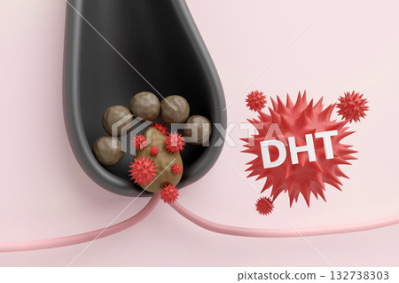 CG 是 DHT 攻擊毛乳頭並導致頭髮稀疏（即雄性禿）的機制之一。 132738303