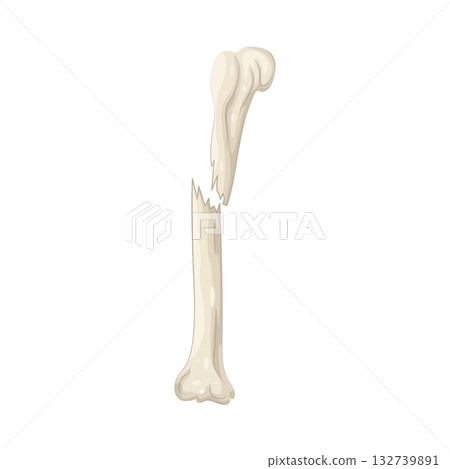 Illustration of fracture  132739891