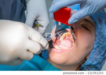 Dental professional uses mouth prop to keep patient mouth open during procedure. Woman wearing surgical cap undergoes dental treatment in hospital 132761255