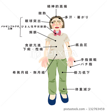 Graves' disease (hyperthyroidism) illustration (female) based on systemic symptoms Graves' disease (hyperthyroidism) illustration (female) based on systemic symptoms 132763459
