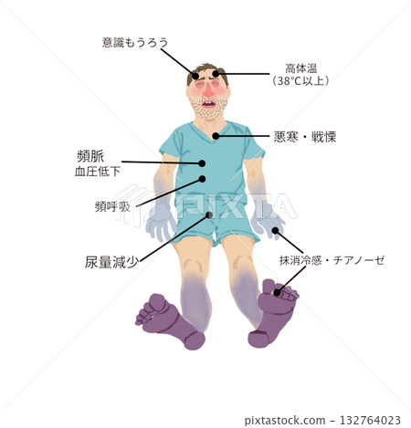 Symptoms of septic shock (nursing and medical teaching materials) 132764023
