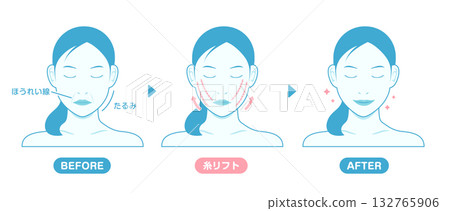 Thread lift treatment details and effects vector illustration 132765906