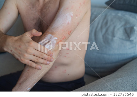 Man applies medicated cream to skin with severe rash and redness relieving discomfort showing effective skincare routine. Man applies medicated cream to skin with severe rash and redness relieving discomfort showing effective skincare routine. 132785546