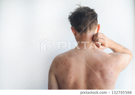 Red itchy spots and blisters on a mans body from insect bites showing severe skin irritation and inflammation in video. Red itchy spots and blisters on a mans body from insect bites showing severe skin irritation and inflammation in video. 132785566