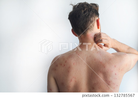 Man with widespread red itchy rash and irritation after taking medication showing adverse drug reaction in video. Man with widespread red itchy rash and irritation after taking medication showing adverse drug reaction in video. 132785567