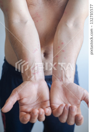 Man experiences severe itching and redness after contact with irritant showing skin inflammation and irritation. Man experiences severe itching and redness after contact with irritant showing skin inflammation and irritation. 132785577