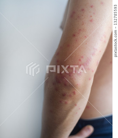 Small red rash spreads across a mans face and body showing gradual merging of spots typical of measles infection. Small red rash spreads across a mans face and body showing gradual merging of spots typical of measles infection. 132785593