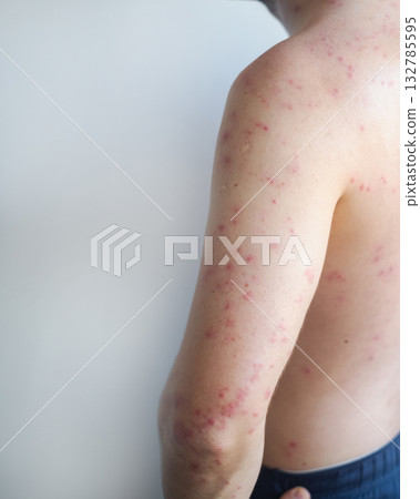 Man with large blisters on torso and arms showing sudden onset of acute hives with redness and swelling. Man with large blisters on torso and arms showing sudden onset of acute hives with redness and swelling. 132785595