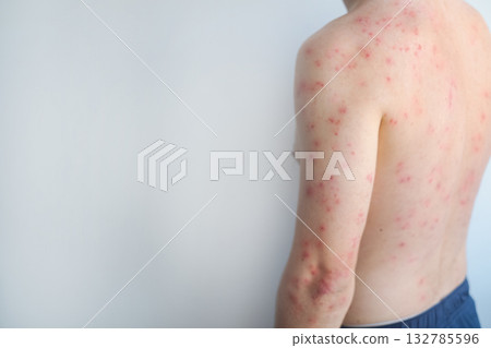 Red rash and blisters cover a man's body showing severe allergic reaction with inflammation and intense itching. 132785596