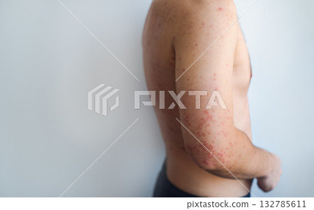 Man with fine pink rash evenly covering skin feeling unwell and weak typical symptoms of viral rubella infection 132785611