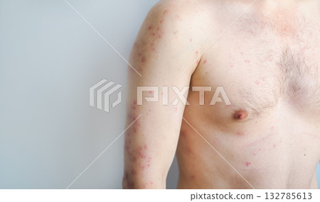 Man with sudden rash large blisters and redness on body typical hives outbreak caused by stress or food allergy 132785613