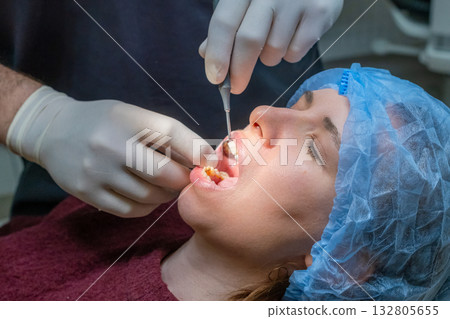 Dental implant preparation with surgical instruments used to work on gum area. Patient mouth open while dental team operates under focused lighting. 132805655