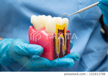 Dentist holding dental implant, artificial tooth roots into jaw, root canal of dental treatment, gum disease, teeth model for dentist. 132811796