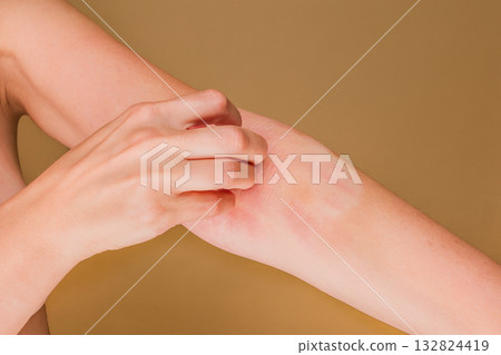 Woman scratching arm with rash and irritation Woman scratching arm with rash and irritation 132824419