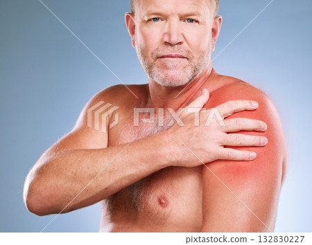 Sunburn, skincare and portrait of a man with red skin color and burn texture in studio. Isolated, blue background and male model looking for wellness, health and soothing solution for body problem 132830227