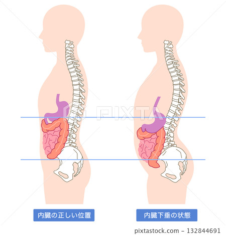 Visceroptosis: A condition in which the internal organs are lowered Visceroptosis: A condition in which the internal organs are lowered 132844691