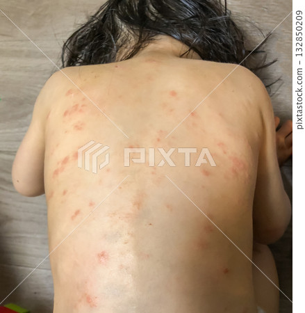 背部患有濕疹的孩子 背部患有濕疹的孩子 132850209