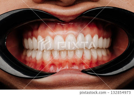 Macro dental exam with cheek retractors showing aligned white veneers and healthy gums Macro dental exam with cheek retractors showing aligned white veneers and healthy gums 132854973