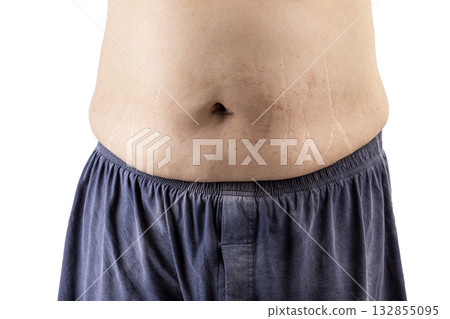 Person showing their belly with visible stretch marks 132855095